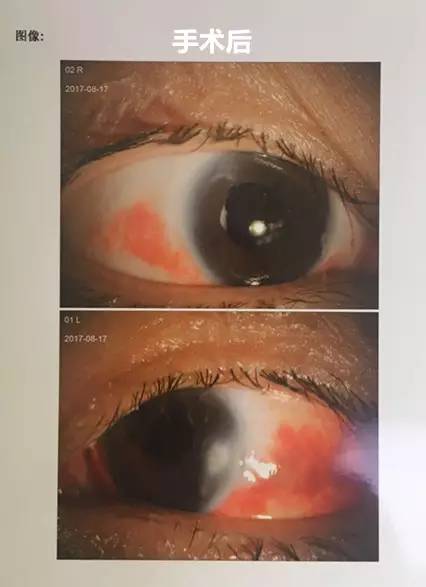 成都太阳成tyc7111cc白内障.jpg 成都太阳成tyc7111cc白内障.jpg