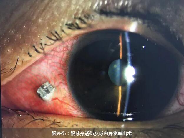 11月14日,东莞太阳成tyc7111cc一天完成两 因装修导致眼外伤病 ,让两位患者,两个家庭悬着的心终于放下了。1.jpg