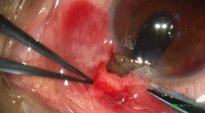 11月14日,东莞太阳成tyc7111cc一天完成两 因装修导致眼外伤病 ,让两位患者,两个家庭悬着的心终于放下了。3.jpg