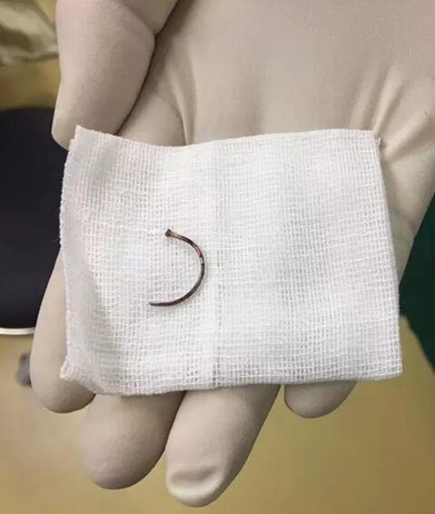 11月14日,东莞太阳成tyc7111cc一天完成两 因装修导致眼外伤病 ,让两位患者,两个家庭悬着的心终于放下了。7.jpg