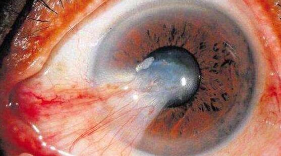 据烟台康爱眼科医院的眼病普查结果显示,当天共筛查149人, 大的94岁, 小的47岁。其中,24人因翼状胬肉急需手术医治,还有12人患有轻度翼状胬肉需随诊。1.jpg 据烟台康爱眼科医院的眼病普查结果显示,当天共筛查149人, 大的94岁, 小的47岁。其中,24人因翼状胬肉急需手术医治,还有12人患有轻度翼状胬肉需随诊。1.jpg