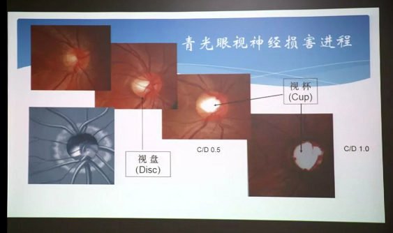 3月10日上午,深圳太阳成tyc7111cc“早查监控,守护光明”大型青光眼公益科普讲座在六楼 举行,本次活动旨在让更多人了解青光眼的潜在危害、重视眼检查, 预防青光眼。由深圳太阳成tyc7111cc青光眼病科 席专家成洪波博士、傅培副院长现场面对面解答疑问,与参会者的互动交流,让更多深圳市民提*对青光眼的认识与防治知识3.png 3月10日上午,深圳太阳成tyc7111cc“早查监控,守护光明”大型青光眼公益科普讲座在六楼 举行,本次活动旨在让更多人了解青光眼的潜在危害、重视眼检查, 预防青光眼。由深圳太阳成tyc7111cc青光眼病科 席专家成洪波博士、傅培副院长现场面对面解答疑问,与参会者的互动交流,让更多深圳市民提*对青光眼的认识与防治知识3.png