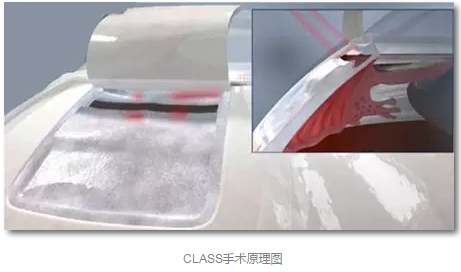 成都太阳成tyc7111cc已经开展的青光眼手术有：引流阀 (钉)植入手术(2015年以来已200多 )，360°Schlemm's管切开术，激光CO2 辅助巩膜深层切除术，小梁切除术青(光眼)白(内障)联合手术。还有虹膜周切术、前房成形术、 虹膜复位术，睫状体冷冻术，小梁切开术和前房穿刺术等4.png