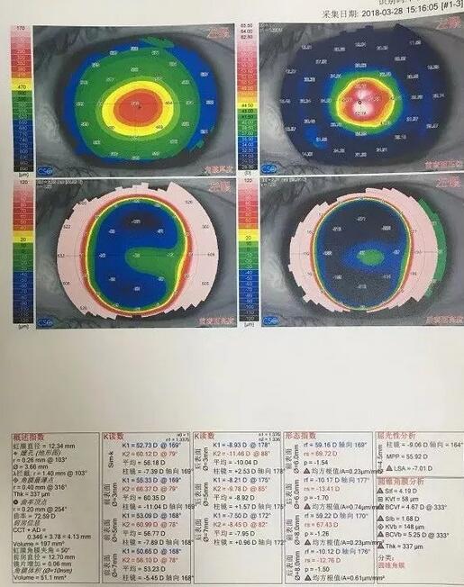 角膜移植是利用异体的正常透明角膜组织,取代浑浊病变的角膜组织,使患者复明或控制角膜病变,这在目前同种器官移植当中, 率是 高的,也是重要的复明手术之一。”在 为一位饱受圆锥角膜之苦患者 实施角膜移植之后,卢敏院长也对患者极为关心的角膜移植相关知识进行介绍。比如哪些患者适合角膜移植手术 角膜移植是利用异体的正常透明角膜组织,取代浑浊病变的角膜组织,使患者复明或控制角膜病变,这在目前同种器官移植当中, 率是 高的,也是重要的复明手术之一。”在 为一位饱受圆锥角膜之苦患者 实施角膜移植之后,卢敏院长也对患者极为关心的角膜移植相关知识进行介绍。比如哪些患者适合角膜移植手术