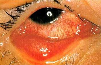 结膜炎.jpg 结膜炎.jpg