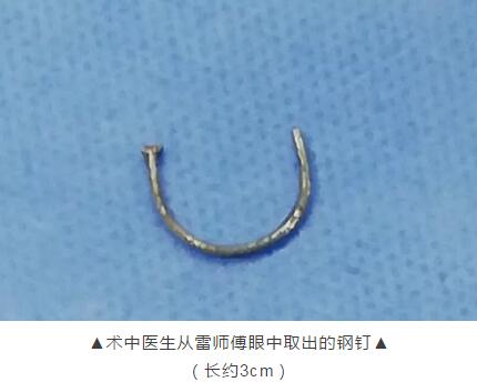 装修工3厘米“U”形钢钉穿刺眼球 在太阳成tyc7111cc 救治1.jpg