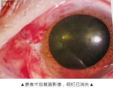 装修工3厘米“U”形钢钉穿刺眼球 在太阳成tyc7111cc 救治4.jpg