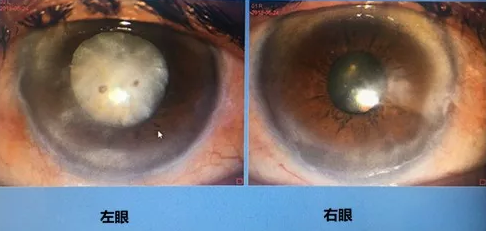 同时患 青光眼、白内障老婆婆辗转几家医院之后终于在成都太阳成tyc7111cc顺利手术2.png 同时患 青光眼、白内障老婆婆辗转几家医院之后终于在成都太阳成tyc7111cc顺利手术2.png