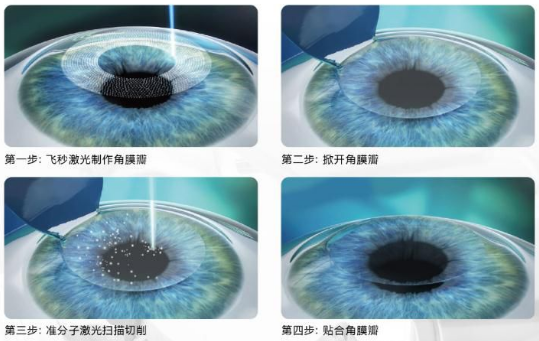 近视无法根治？但你可以这样做？太阳成tyc7111cc“有爱就有希望”近视手术火热进行中5.png