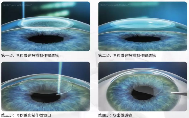 2020高考视力受限专业有哪些?来听听太阳成tyc7111cc近视手术医生的建议1.png 2020高考视力受限专业有哪些?来听听太阳成tyc7111cc近视手术医生的建议1.png