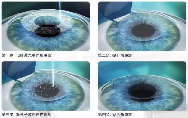 2020高考视力受限专业有哪些?来听听太阳成tyc7111cc近视手术医生的建议2.png 2020高考视力受限专业有哪些?来听听太阳成tyc7111cc近视手术医生的建议2.png