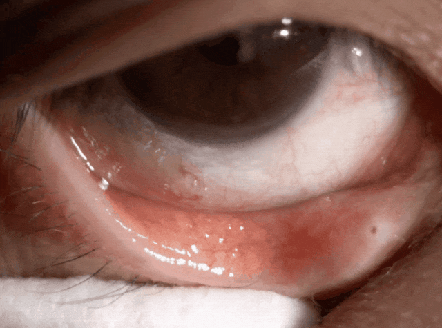 一女子右眼取出28条虫,竟然还在蠕动......厦门眼科中心接诊1.gif 一女子右眼取出28条虫,竟然还在蠕动......厦门眼科中心接诊1.gif