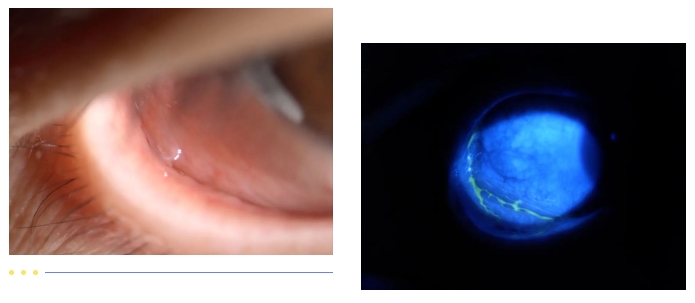 一女子右眼取出28条虫,竟然还在蠕动......厦门眼科中心接诊2.png 一女子右眼取出28条虫,竟然还在蠕动......厦门眼科中心接诊2.png